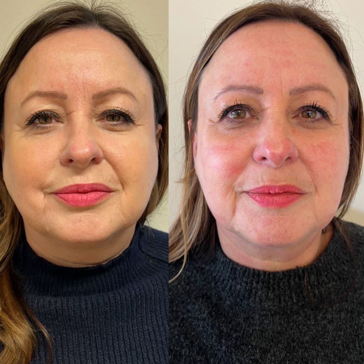 Jawline Slimming